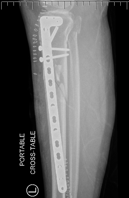 Proximal tibial plate